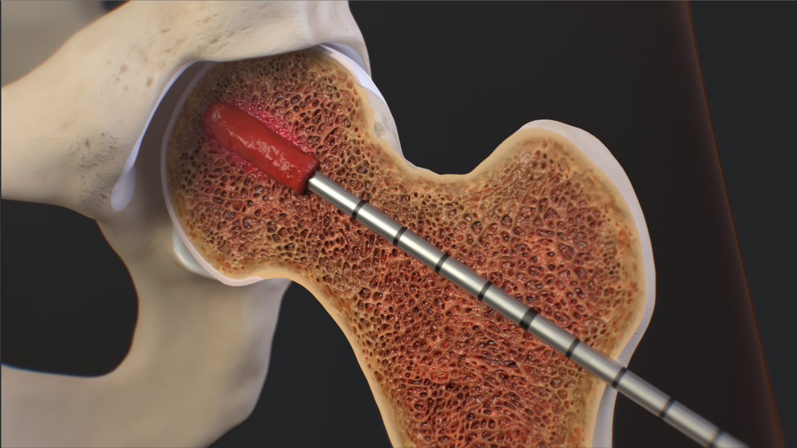 Cross-sectional illustration of a bone lesion treated with an intraosseous instrument